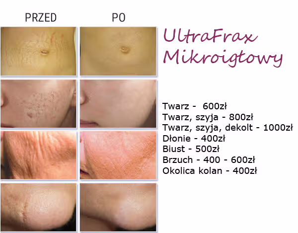 ultrafax mikroigłowy