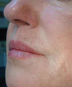 Preparat ProfHilo jest jednym z najbezpieczniejszych specjalistycznych preparatów dermatologicznych do liftingu i odmładzania twarzy.