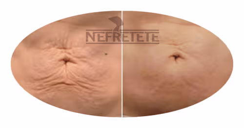 Ultrafrax Nefretete